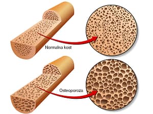 osteoporoza